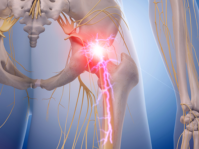 Image of hip sciatica pain for the orphan GPCR spotlight