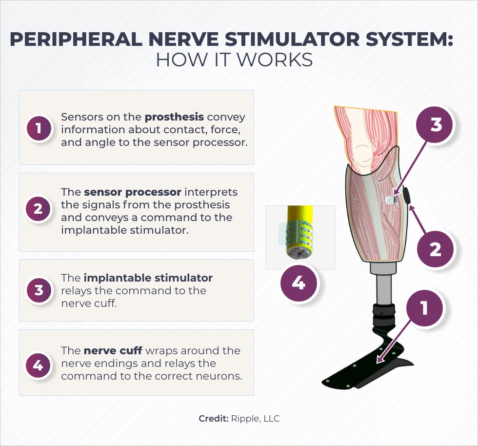 Newly invented electrical stimulation (ES) device improves nerve  regeneration in humans