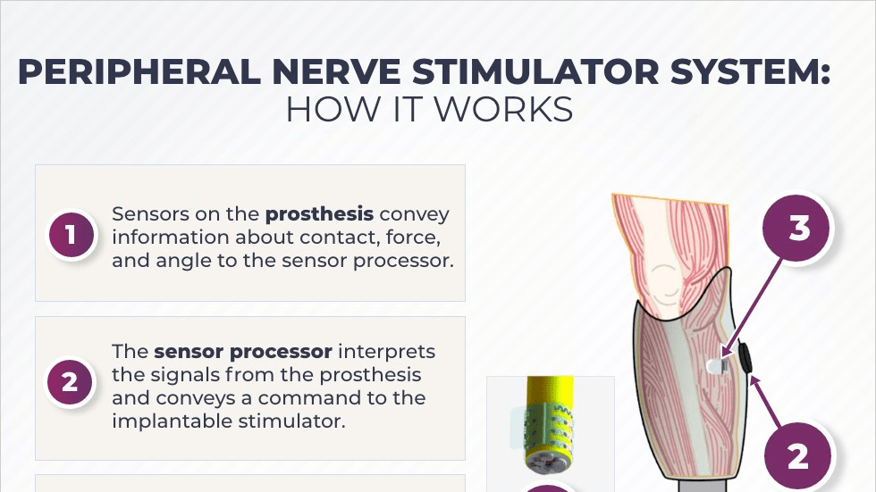 Diagram of the peripheral nerve stimulator system