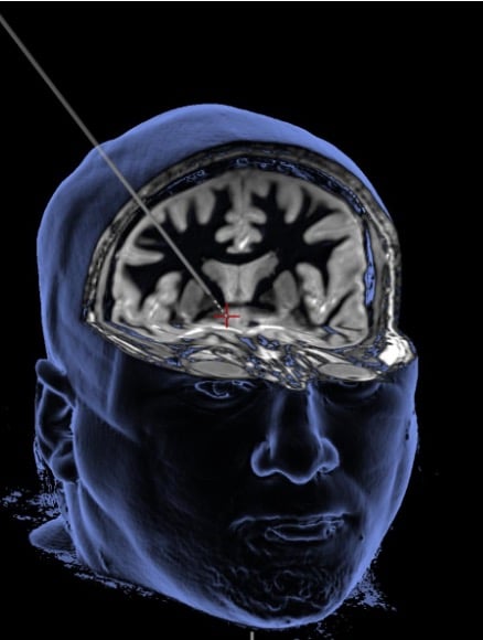 Deep brain stimulation delivers a mild electrical current through a thin wire to alter brain activity in the brain’s reward center (see red plus sign)