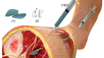 Image of a nerve stimulator, a kind of electrode, being applied.