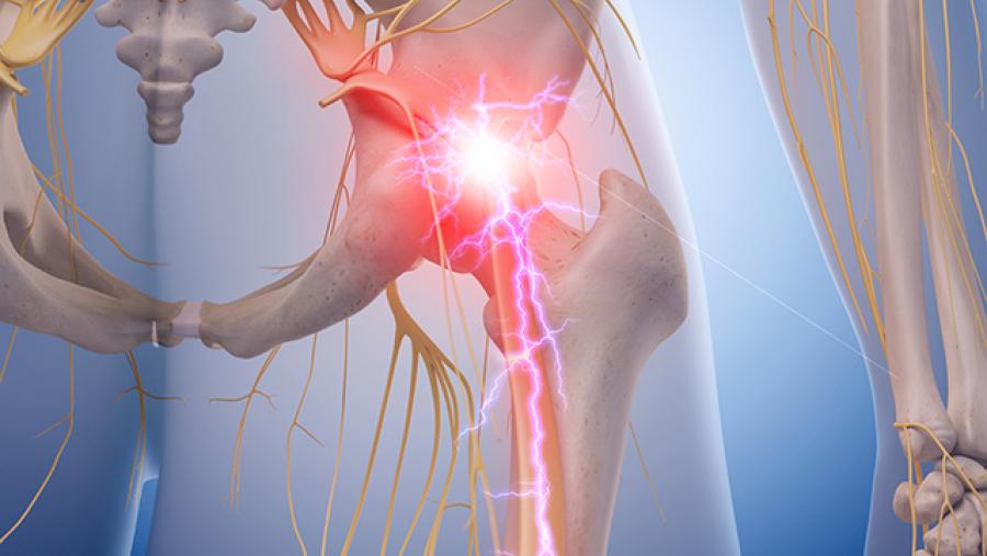 Image of hip sciatica pain for the orphan GPCR spotlight