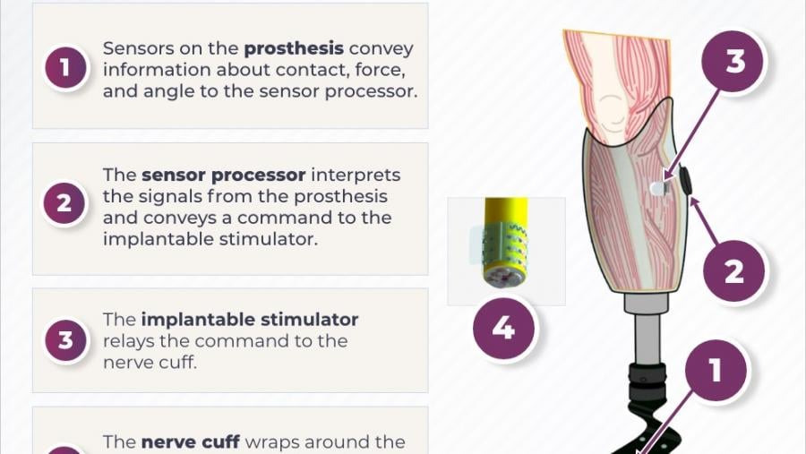 Illustration of a device that stimulates the nerves and alleviates phantom limb pain.