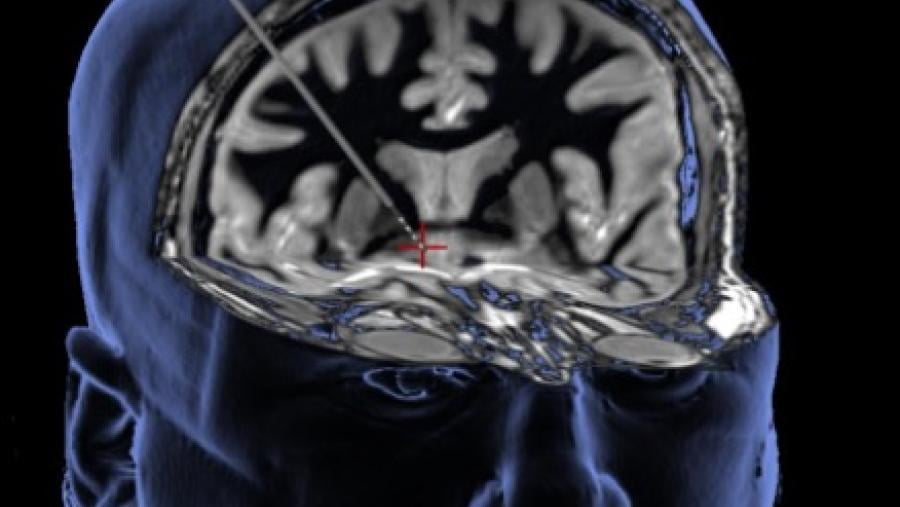 Deep brain stimulation delivers a mild electrical current through a thin wire to alter brain activity in the brain’s reward center (see red plus sign)