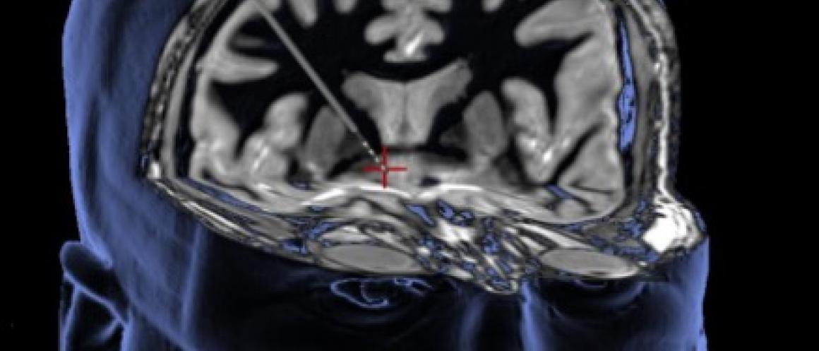 Deep brain stimulation delivers a mild electrical current through a thin wire to alter brain activity in the brain’s reward center (see red plus sign)